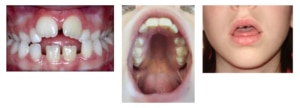 Dental Thumbsucking Collage 1